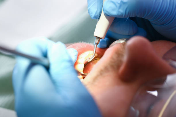 Best Chipped Tooth Repair Near Me  in Warm Mineral Springs, FL